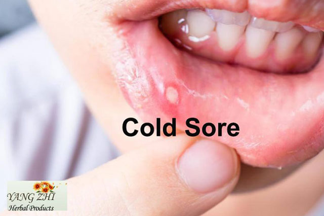 CHINESE MEDICINE FOR COLD SORES
